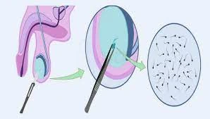 Genix Fertility Care | Cost for IVF Procedure in Bhubaneswar, Odisha >> Impaired Sperm Production or Function
